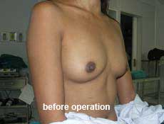 plastic-surgery-breast-augmentation 